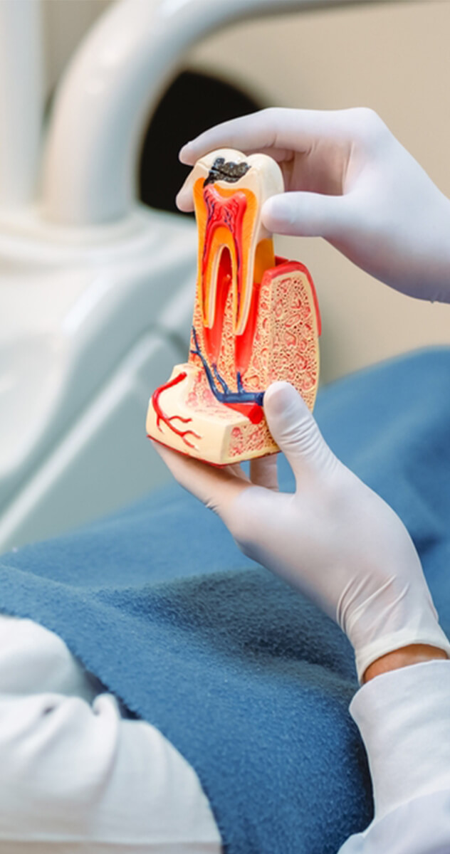 Root Canal Treatment