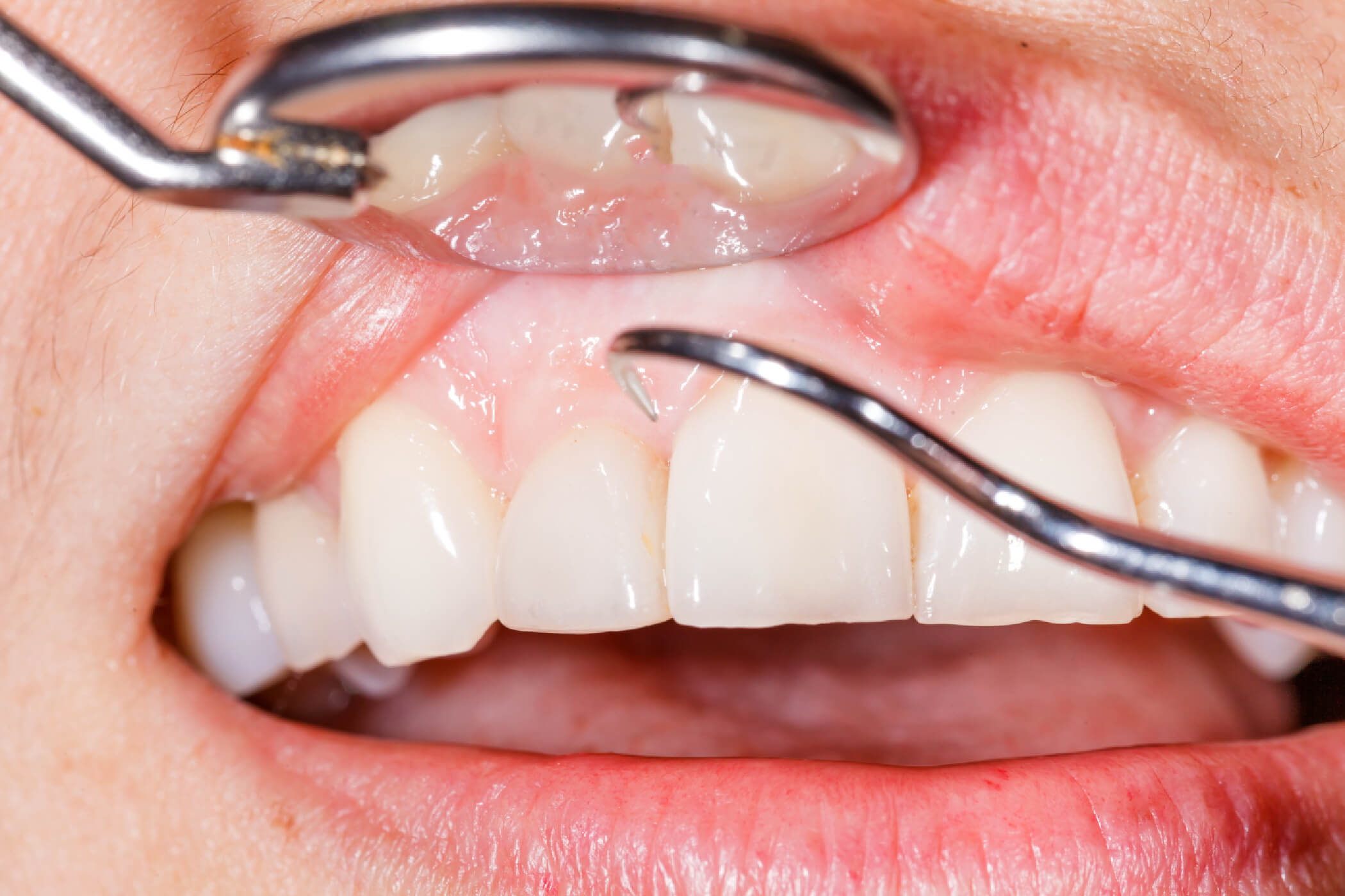 How To Prevent Gum Disease