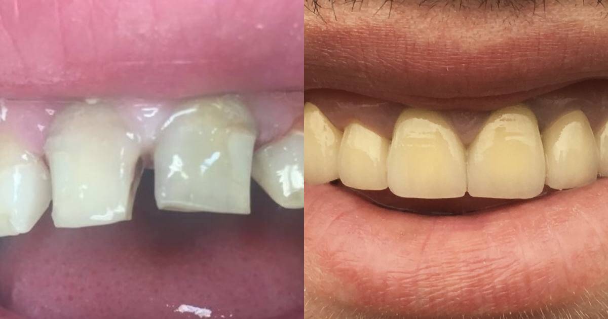 Porcelain Crown Fitting For Tooth Decay