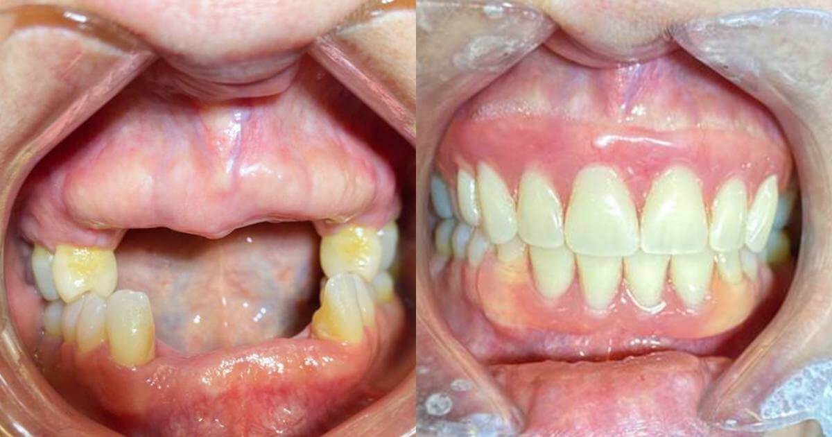 Flexi Denture For Tooth Loss