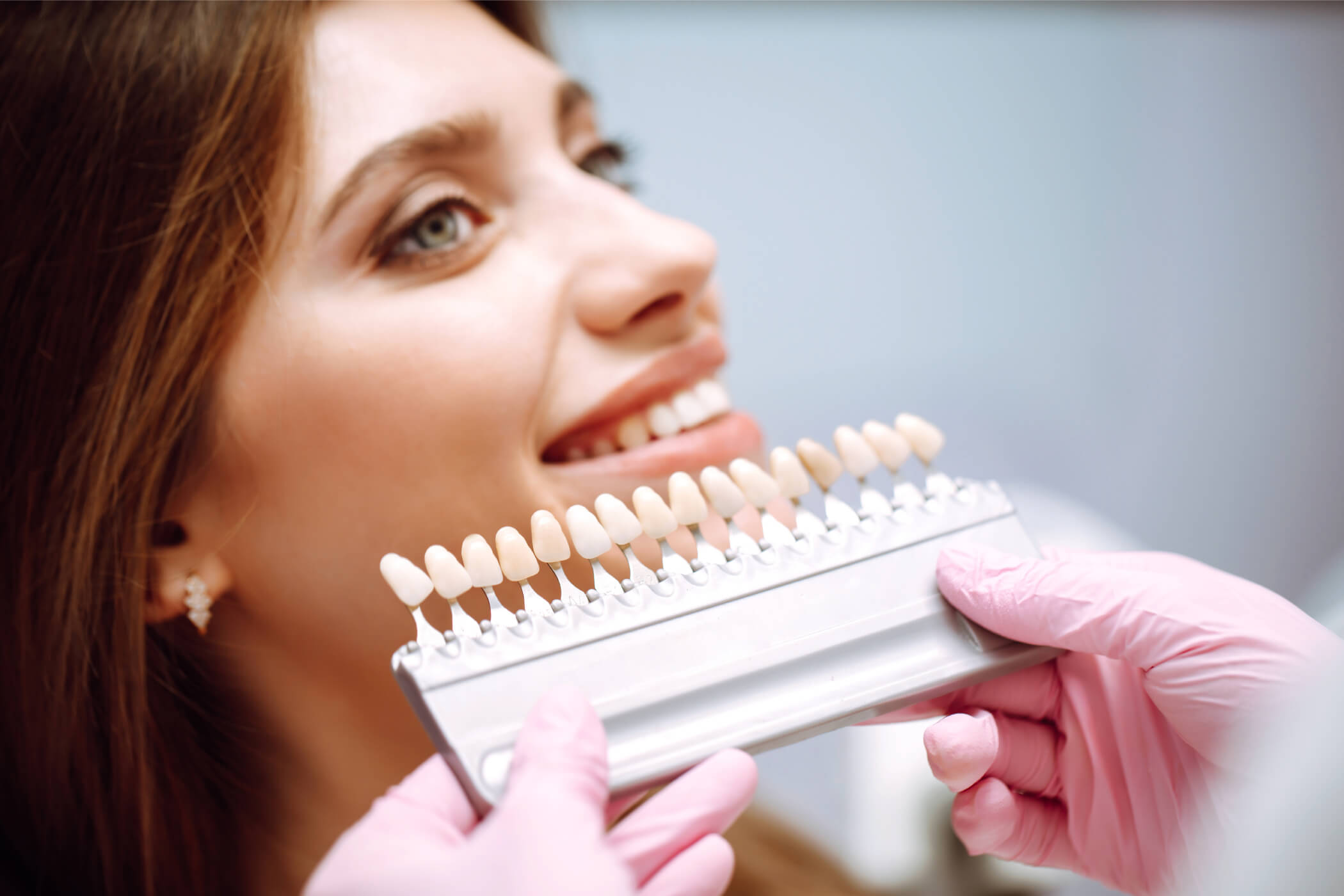 What Are Veneers?