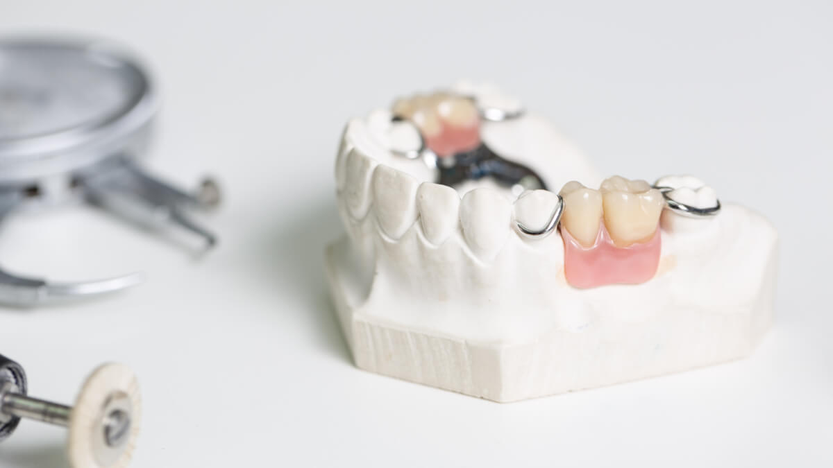 Dental bridge example